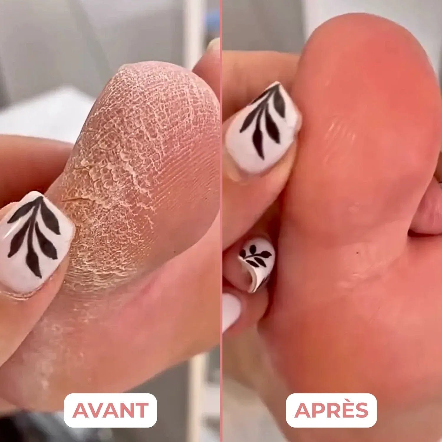 Castanella HoneyGlow – Appareil Anti-Callosités